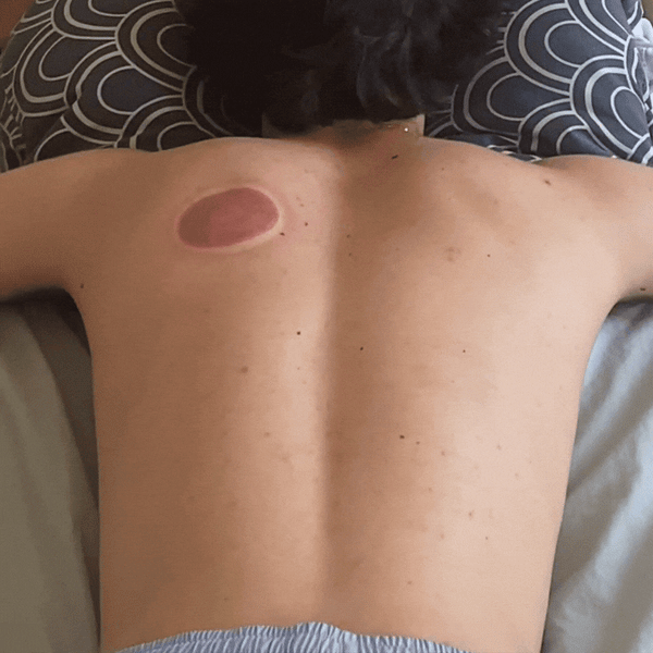 Masseur à ventouse